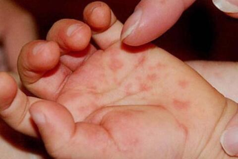 Giai đoạn khởi phát của bệnh tay chân miệng có biểu hiện gì?