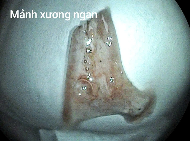 Người đàn ông cấp cứu sau bữa ngan luộc