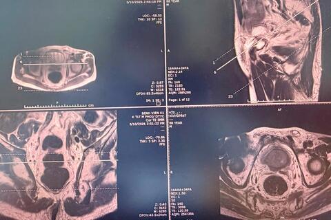 Sinh thiết đích qua tầng sinh môn, bệnh nhân ung thư tiền liệt tuyến được can thiệp kịp thời, điều trị ổn định