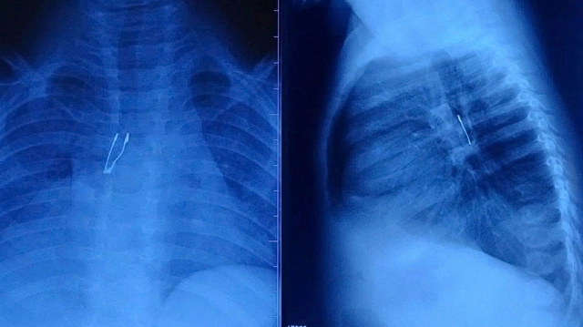 Bé 9 tháng tuổi sặc bóng đèn LED, nhập viện nguy kịch