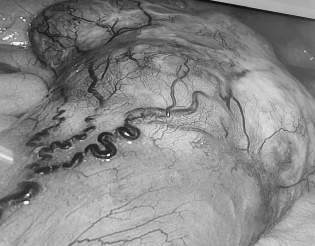 Một bệnh nhân cùng lúc phát hiện mắc 2 khối u ác tính- Ảnh 1. Một bệnh nhân cùng lúc phát hiện mắc 2 khối u ác tính- Ảnh 1.