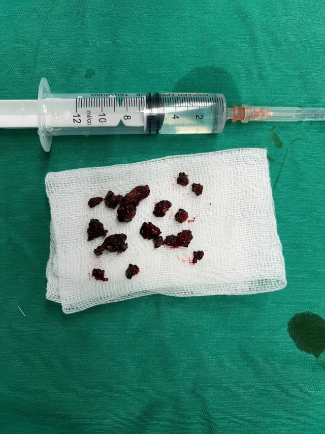 Nấm đen 'ăn' mòn xoang hàm người đàn ông khỏe mạnh- Ảnh 3. Nấm đen 'ăn' mòn xoang hàm người đàn ông khỏe mạnh- Ảnh 3.