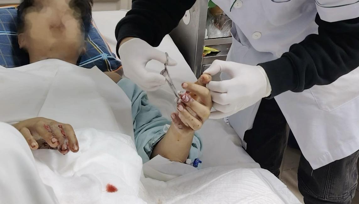 Trẻ 15 tuổi bị biến dạng khuôn mặt, tổn thương nghiêm trọng do tai nạn pháo nổ- Ảnh 2.