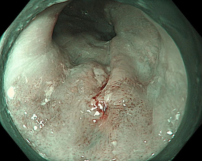 Bệnh viện K ứng dụng hệ thống siêu âm nội soi phóng đại x150 lần, tạo đột phá về tầm soát, điều trị ung thư- Ảnh 3.