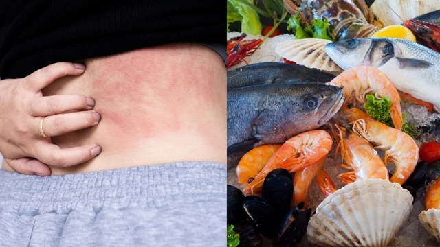 Cách phòng ngừa dị ứng hải sản khi đi biển dịp nghỉ lễ 30/4- Ảnh 3.